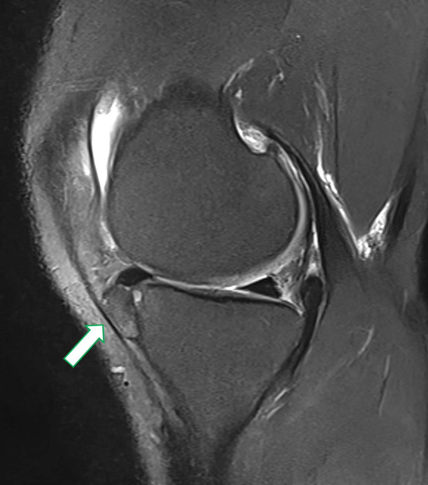 RM do joelho, sagital com supressão de gordura: material de sinal intermediário a baixo junto ao corno anterior do menisco medial, com erosão óssea adjacente