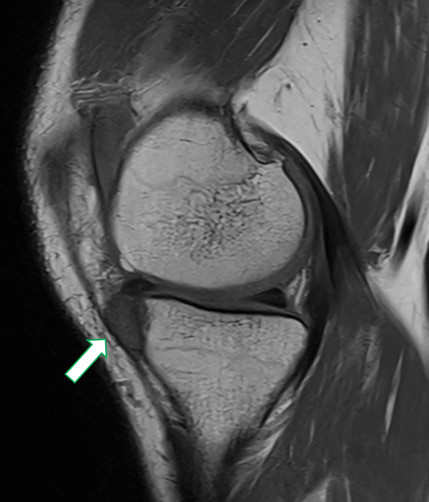 RM do joelho, sagital em T1: o mesmo material junto ao corno anterior do menisco medial, com erosão óssea
