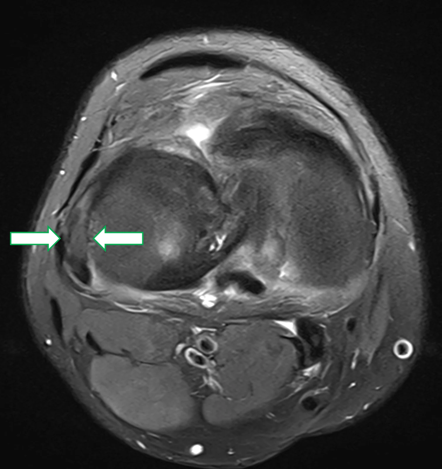 RM do joelho, axial com supressão de gordura: material de sinal intermediário a baixo junto à origem femoral do tendão poplíteo