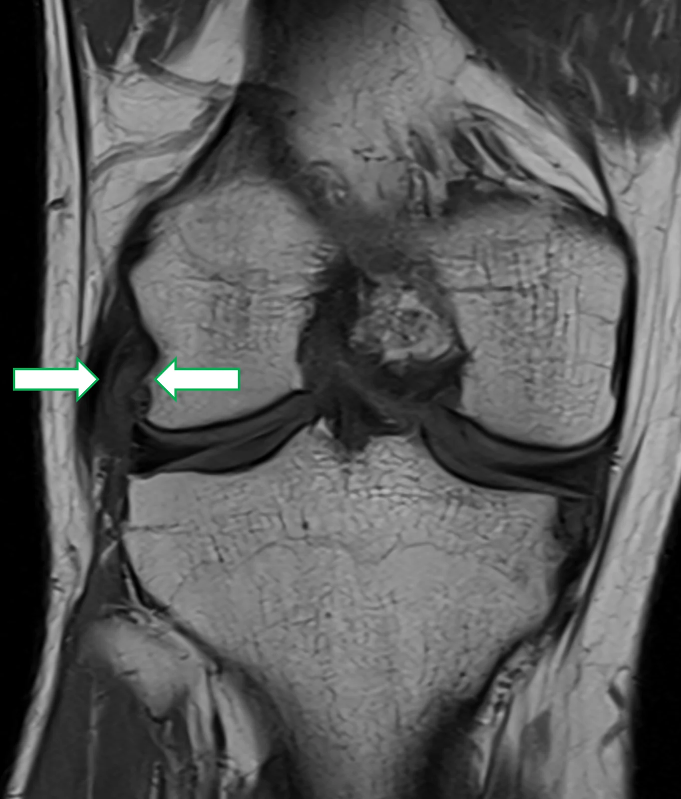 RM do joelho, coronal em T1: o mesmo material junto à origem femoral do tendão poplíteo