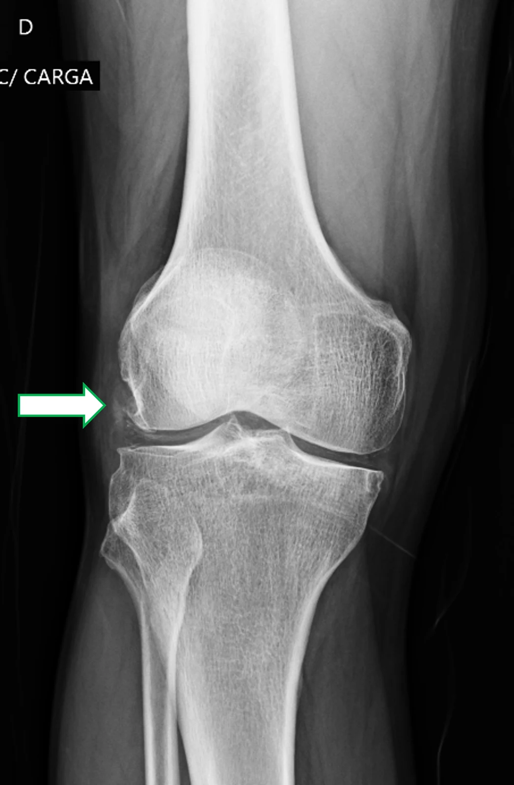 Radiografia do joelho direito, frontal com carga: material hiperdenso junto à origem femoral do tendão poplíteo