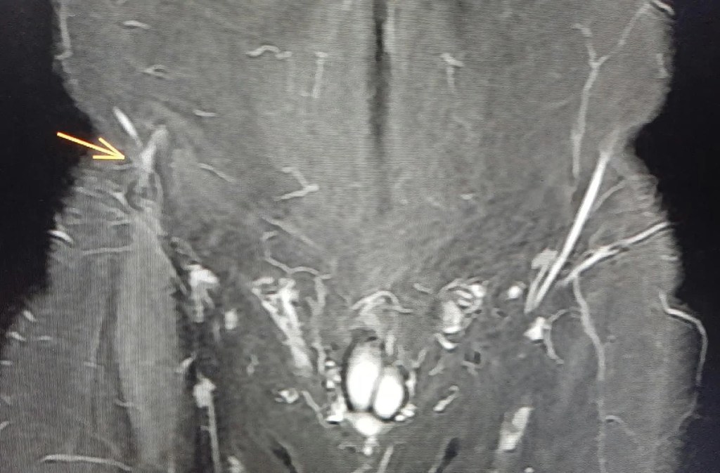 RM coronal da pelve, com seta na região inguinal lateral